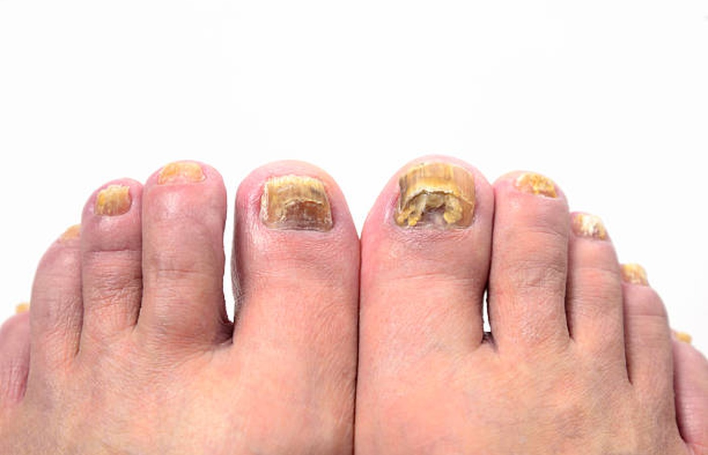 Fungal Nails wellness guides